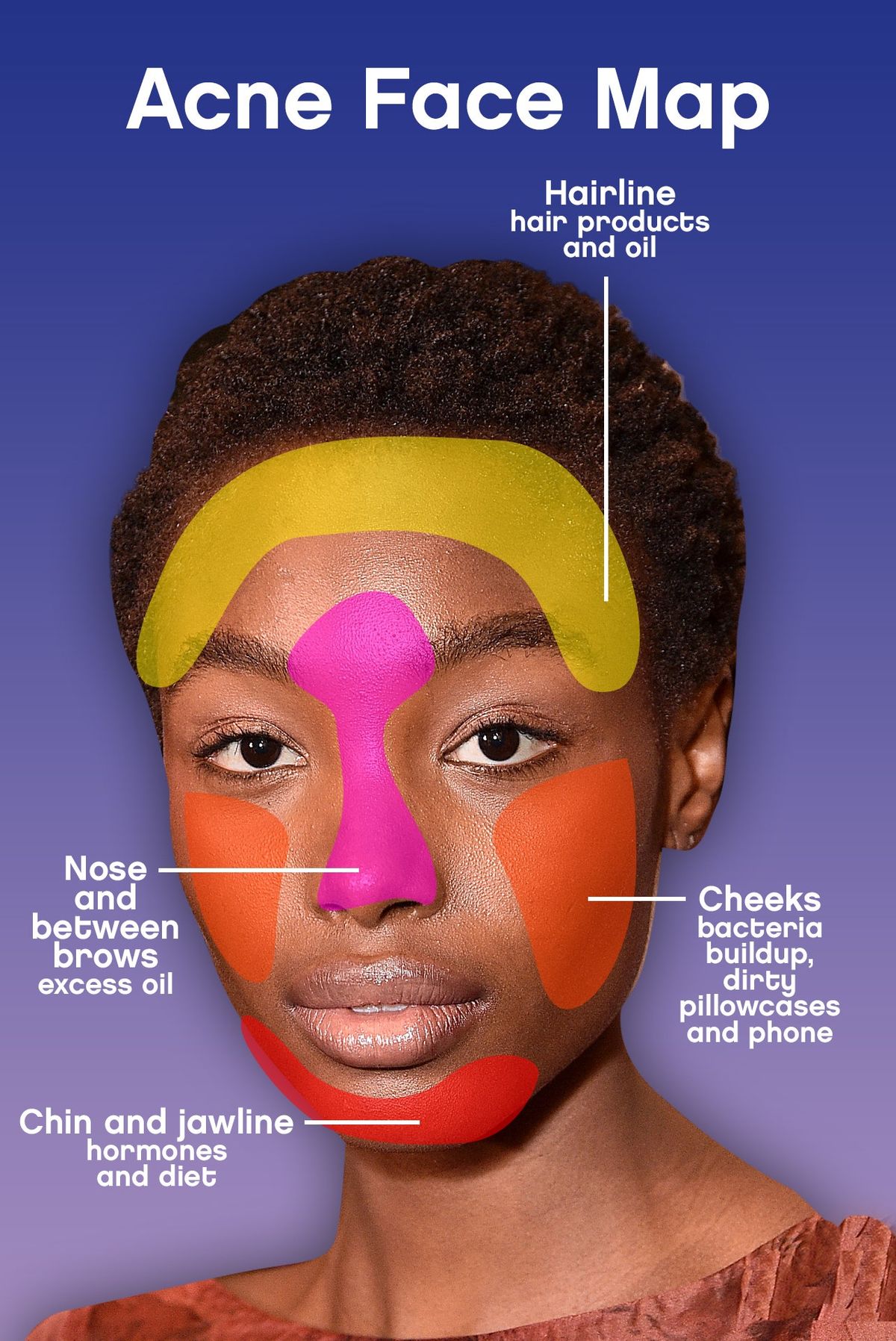 Acne ansiktskarta